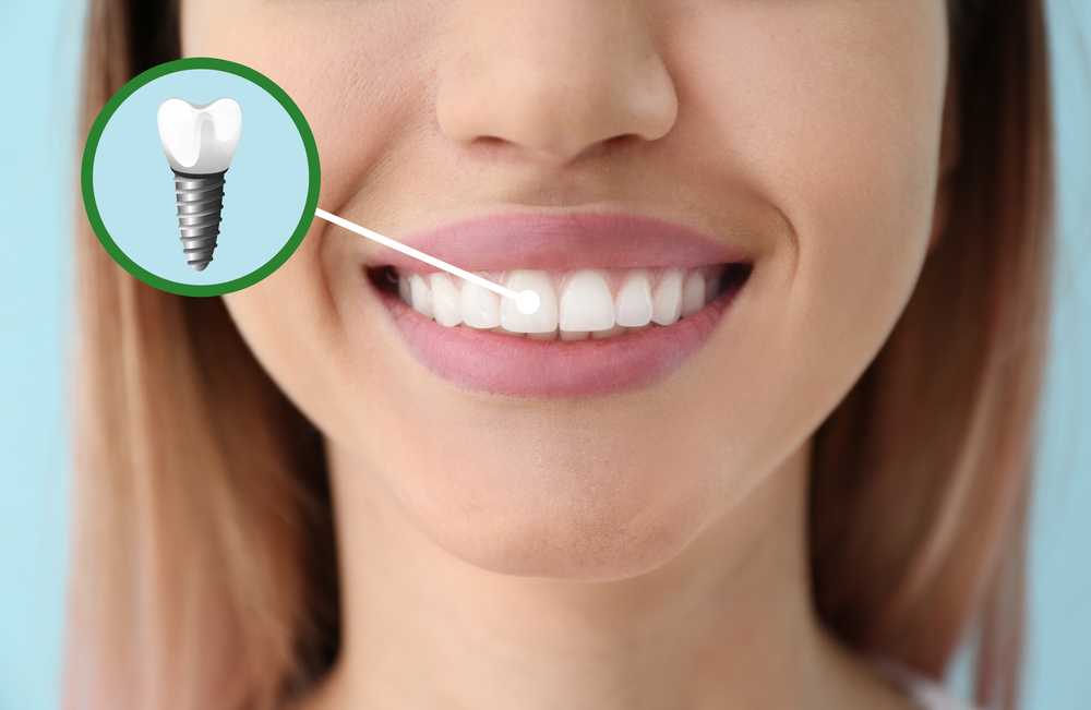 dental implants cost in canada featured image