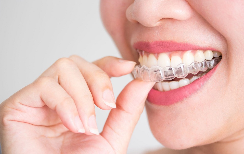 women wearing invisalign